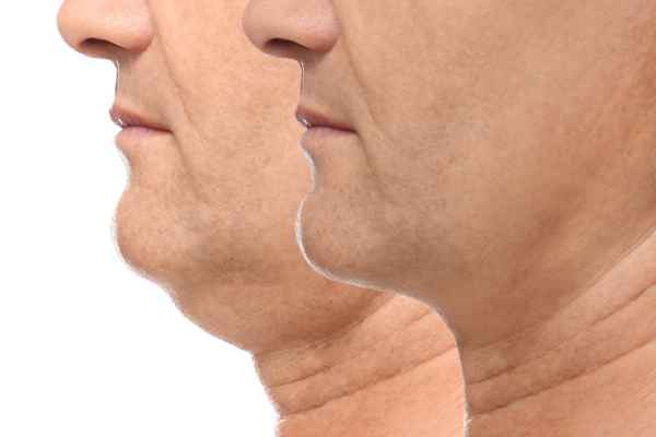 HIFU - Breakthrough in Anti - ageing 2 hifu results Woking