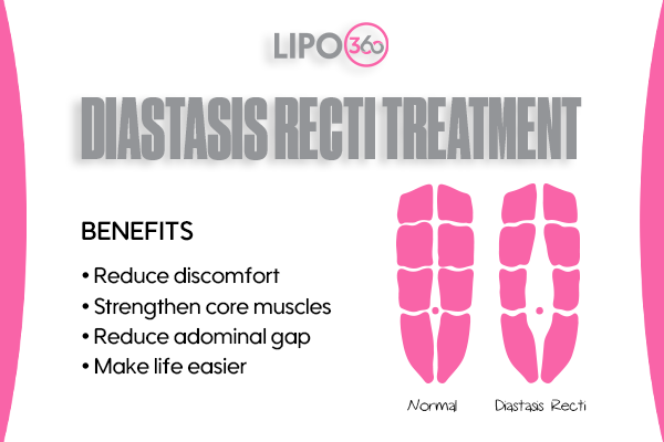Revolutionising Muscle Repair: The Power of LIPO360 Body Sculpt Post-Injury 5 diastasis recti treatment Woking