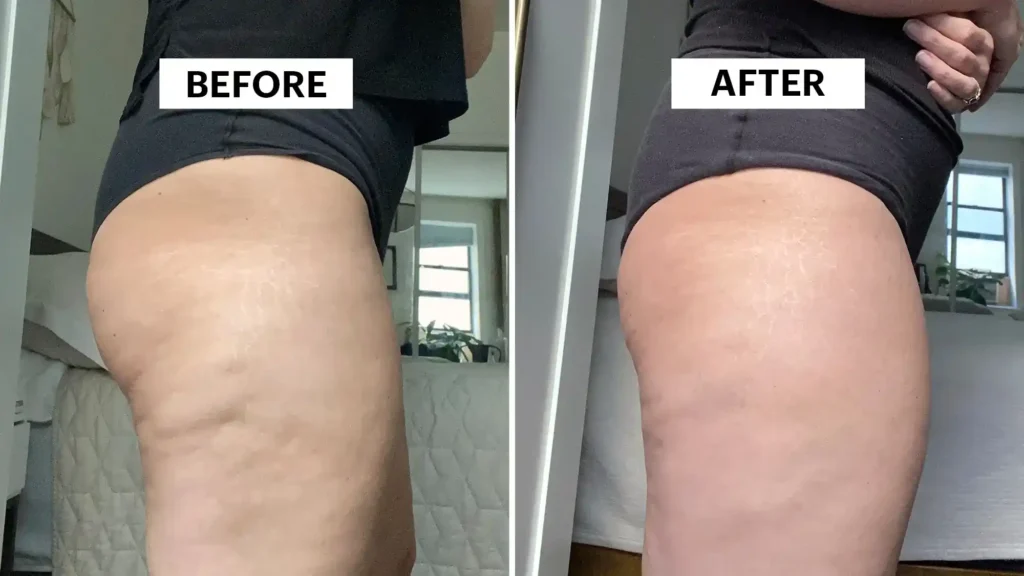 Sculpting Your Bum: Can Toning Exercises Really Reduce Cellulite? 1 Do Toning Exercise Woking Really Tackle Cellulite?