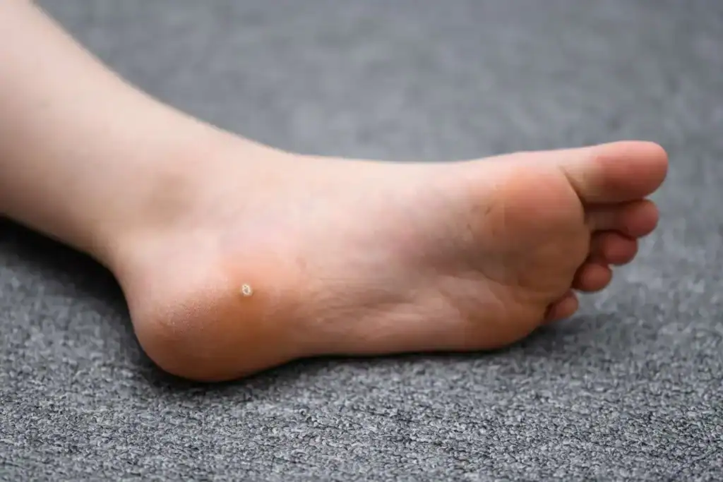 Cryotherapy For Warts And Also Verrucas 2 Image of verruca on the bottom of the foot that able to be treated with Cryotherapy Woking