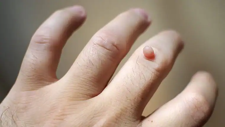 Cryotherapy For Warts And Also Verrucas 1 Image of blemish that Cryotherapy Woking can remove with Lipo 360.