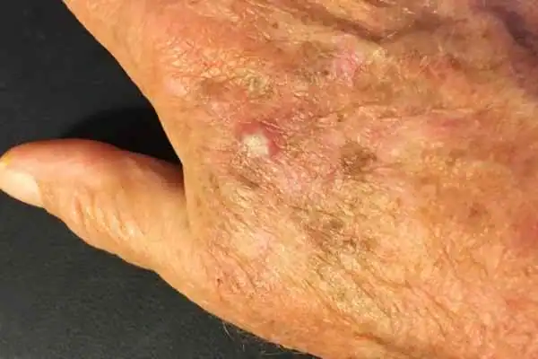 Image of Actinic keratoses Woking on a person hand
