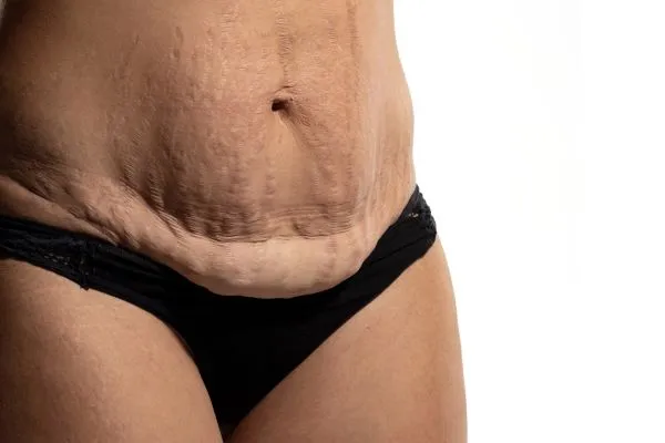 The Science of Skin Tightening 1 The science behind skin tightening Woking picture of a woman's sagging skin on the stomach